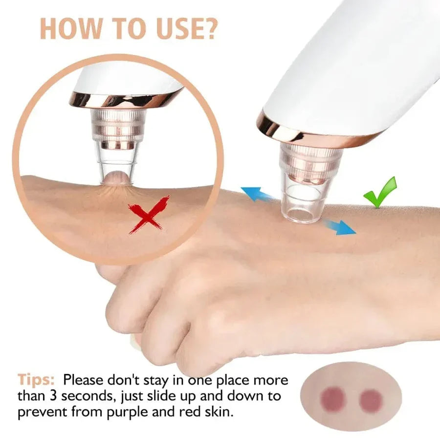 Electric Blackhead Remover, Vacuum Acne Cleaner, Black Spots Removal Device